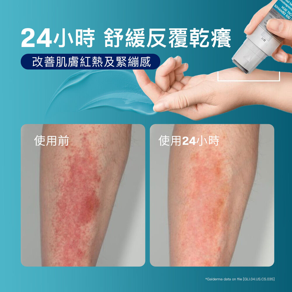 AD益膚康瞬效舒敏凝膠