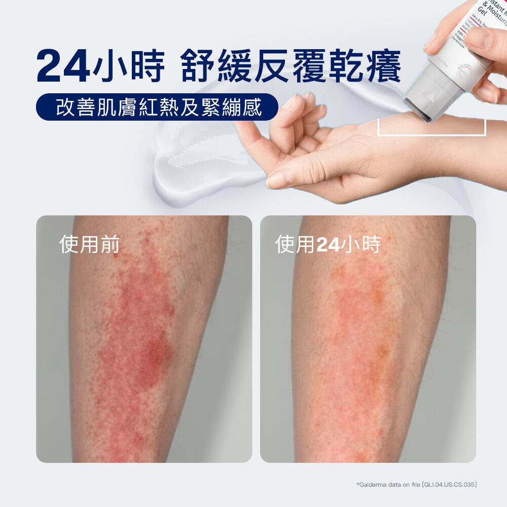 AD益膚康瞬效舒敏凝膠